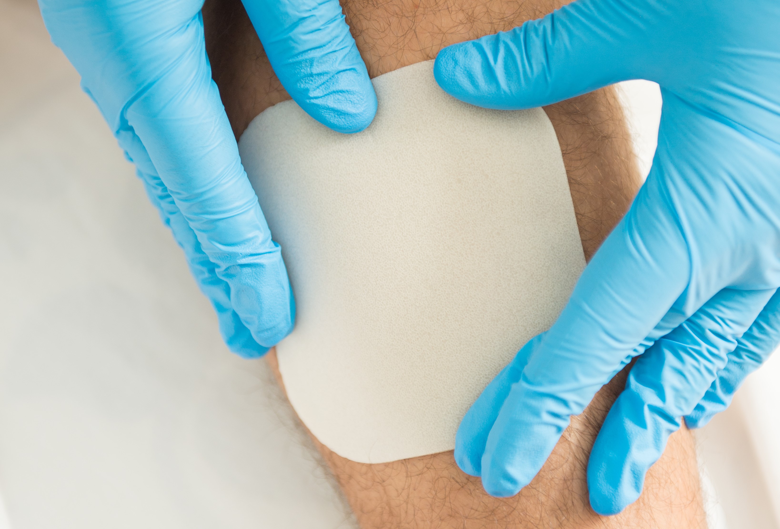 Benefits of Hydrocolloids in Advanced Wound Care
