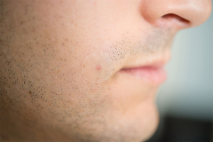 Do Hydrocolloid Bandages Really Heal to Treat Acne?