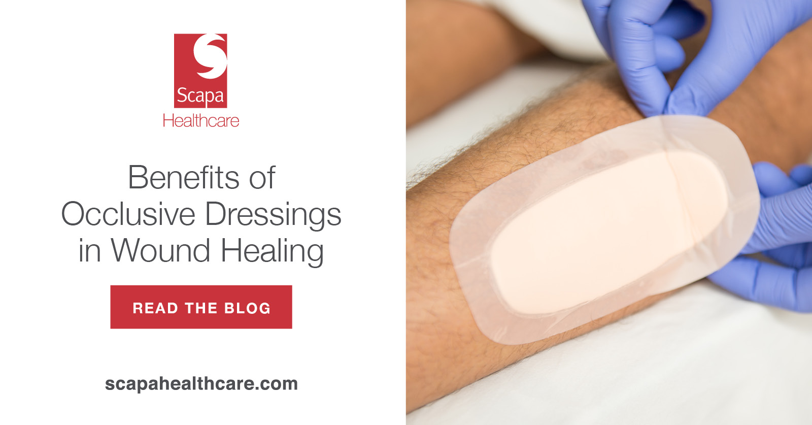 Benefits of Occlusive Dressings in Wound Healing